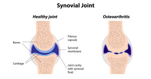 healthy joint vs osteoarthritis diagram