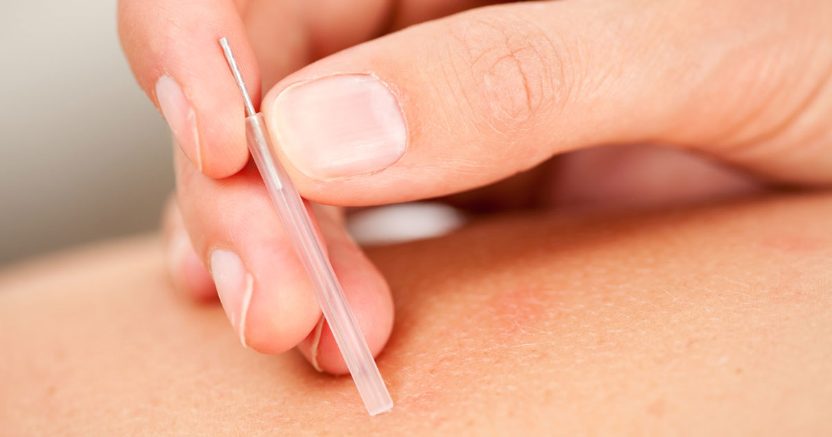 Dry needling: What is it and how is it different to acupuncture?