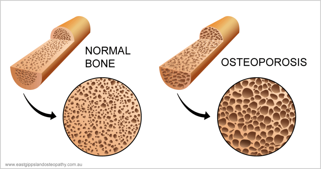 Pathophysiology Of Osteoporosis Diagram