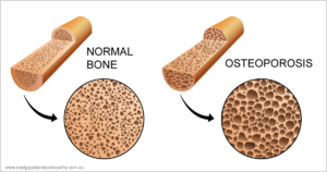 prevention management osteoporosis