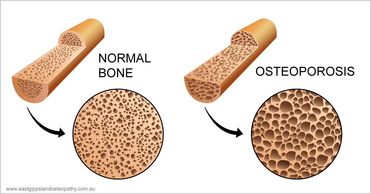 Prevention and management of Osteoporosis
