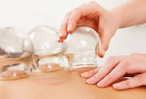 Dry Needling and Myofascial Cupping
